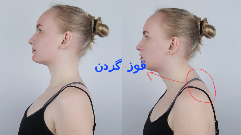 درمان کیفوز گردن در کلینیک دکتر سعادتی