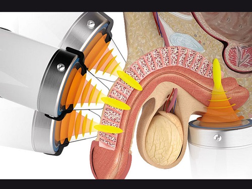 روش انجام شاک ویو تراپی برای درمان بیماری پیرونی