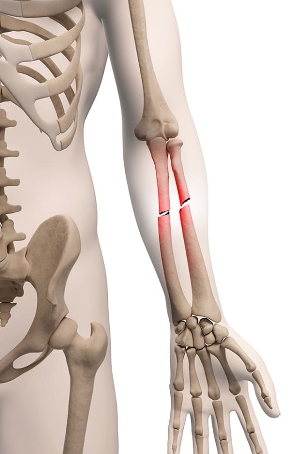 دیر جوش خوردن استخوان