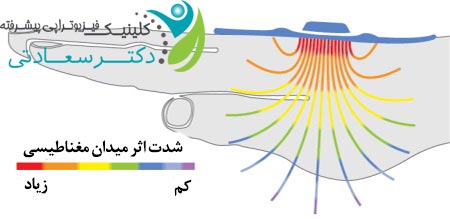 درمان نقرص با مگنت درمانی