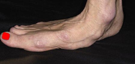 علائم روماتیسم مفصلی پا