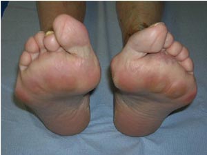 درمان روماتیسم مفصلی پا