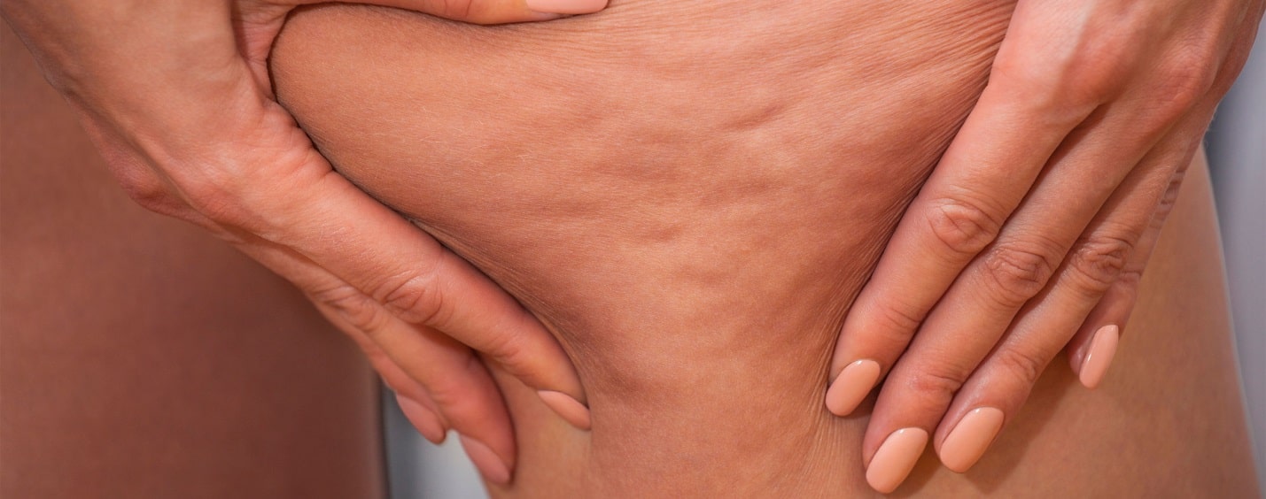 سلولیت سفت یا فشرده