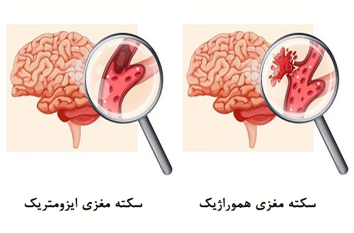 انواع سکته مغزی