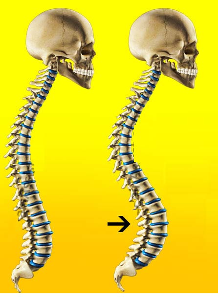 علائم گودی کمر